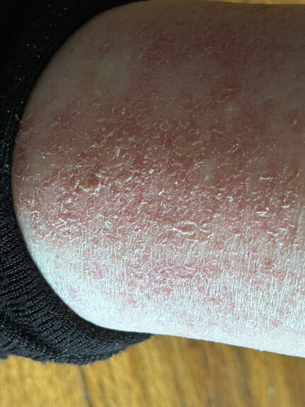 Morgellons disease, germ warfare, phosphorescence, filaments, Joni Mitchell, Sheryl Crow, Kaiser Permanente study, biological research, dermatological conditions, experimental technologies, health controversies