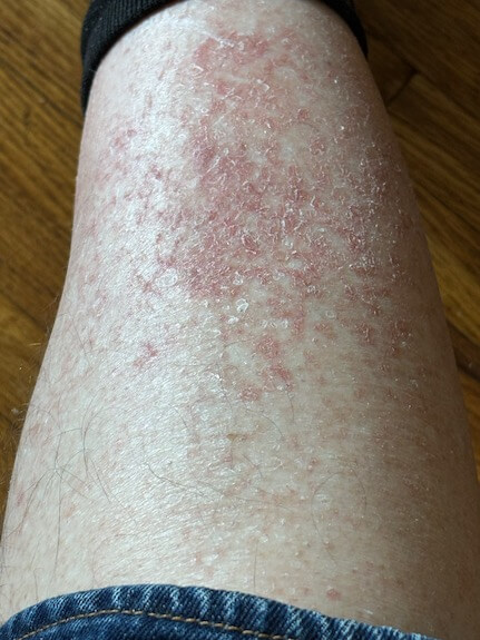 Morgellons disease, germ warfare, phosphorescence, filaments, Joni Mitchell, Sheryl Crow, Kaiser Permanente study, biological research, dermatological conditions, experimental technologies, health controversies